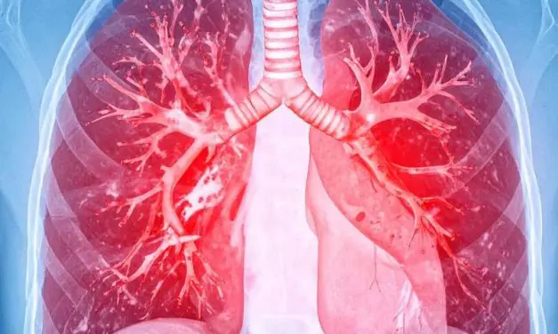 Catheter-based ultrasound thrombolysis significantly reduces the risk of severe pulmonary embolism