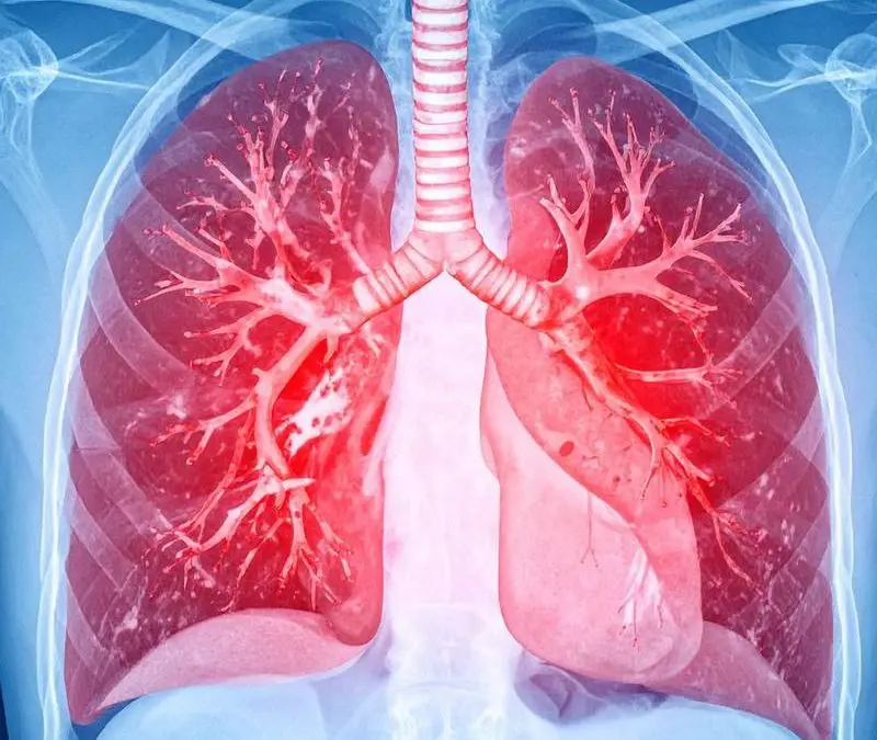 Catheter-based ultrasound thrombolysis significantly reduces the risk of severe pulmonary embolism