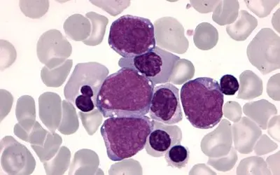 GATA1 mutation fuels leukemia development in children with Down syndrome