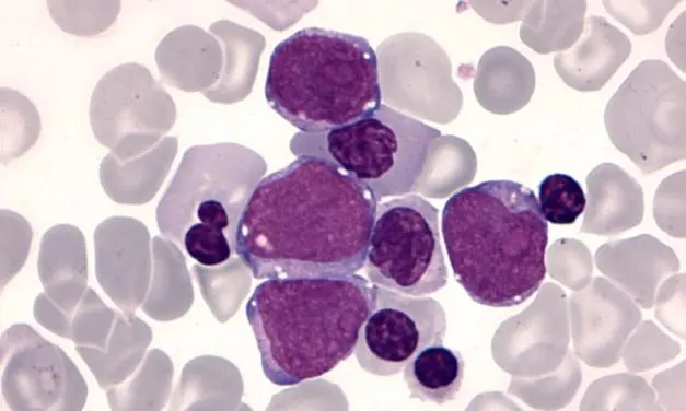 GATA1 mutation fuels leukemia development in children with Down syndrome