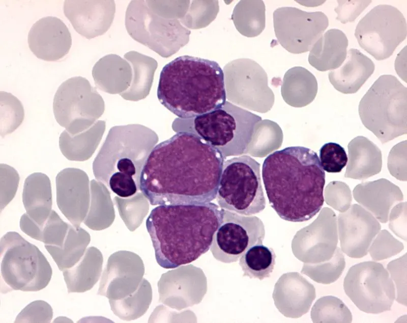 GATA1 mutation fuels leukemia development in children with Down syndrome