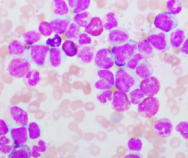 Physicians weaken leukemia cells through targeted false alarm response