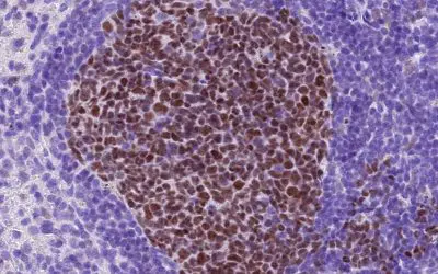 cFLIP discovered as a new target against therapy-resistant lymphomas