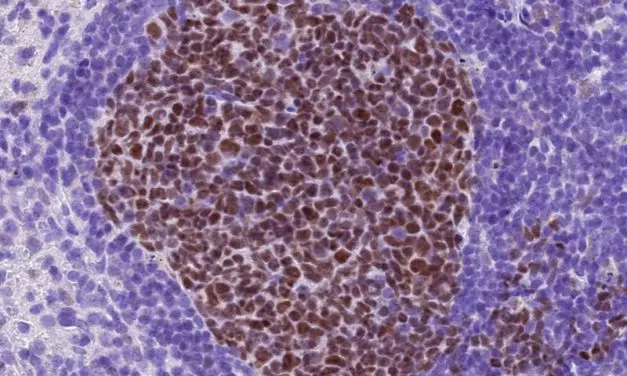 cFLIP discovered as a new target against therapy-resistant lymphomas