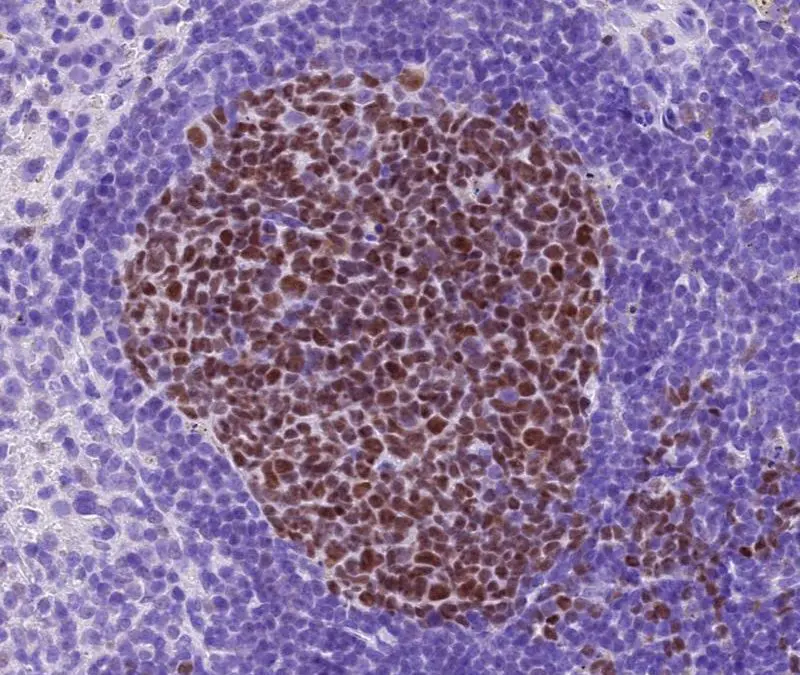 cFLIP discovered as a new target against therapy-resistant lymphomas