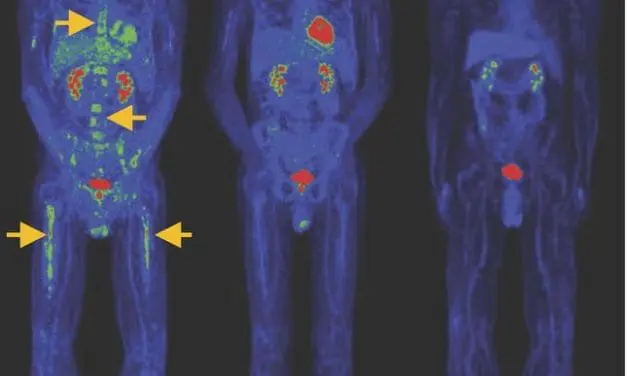 New CAR-T cells with stem memory phenotype show promising effect in blood cancers