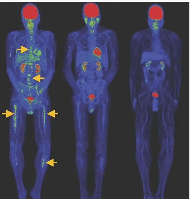New CAR-T cells with stem memory phenotype show promising effect in blood cancers