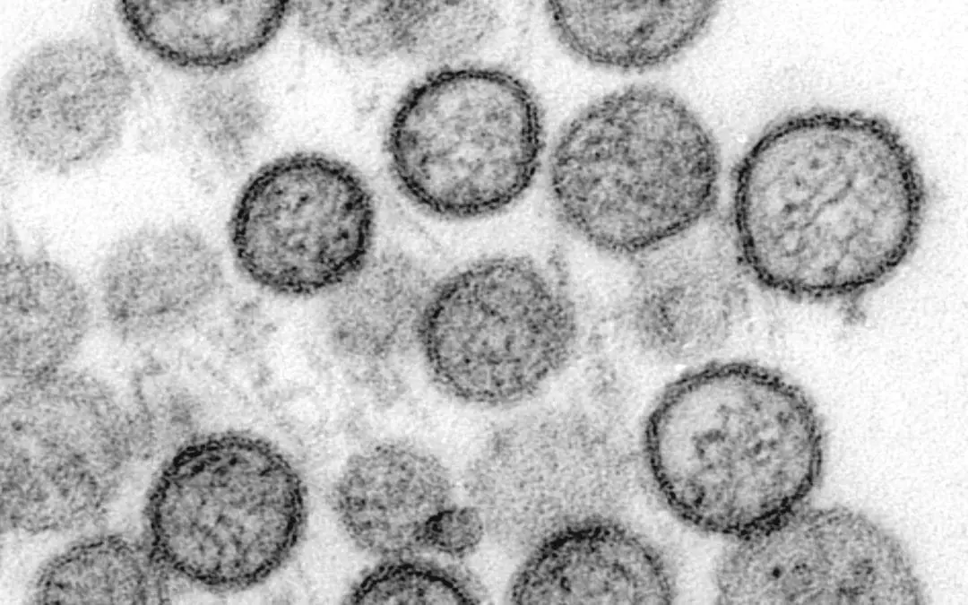 Hantavirus: detection, symptoms, therapy