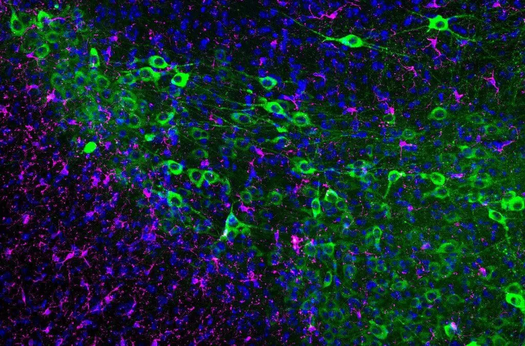 New immune cells discovered in the Alzheimer’s brain