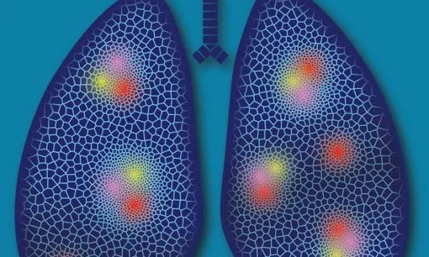 New metabolic approach to fight lung cancer discovered