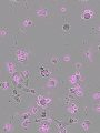 Nach einer Behandlung mit Cas12a2 sterben menschliche Gebärmutterhalskrebszellen (grau dargestellt) großflächig ab, erkennbar an den Apoptose-Markern (magenta). | Copyright: Liu Lab / University of Utah Health
